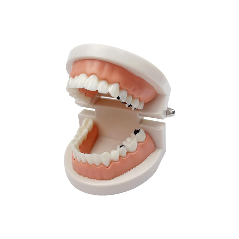 Decay Tooth Model, YOUYA Dental Caries Standard Teeth Teaching Model Study Tool Adult Disease Standard Typodont Demonstration Teeth Model for Kids Oral Care Teaching