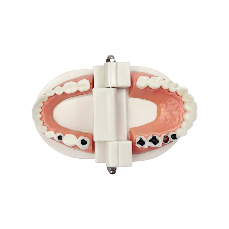 Decay Tooth Model, YOUYA Dental Caries Standard Teeth Teaching Model Study Tool Adult Disease Standard Typodont Demonstration Teeth Model for Kids Oral Care Teaching