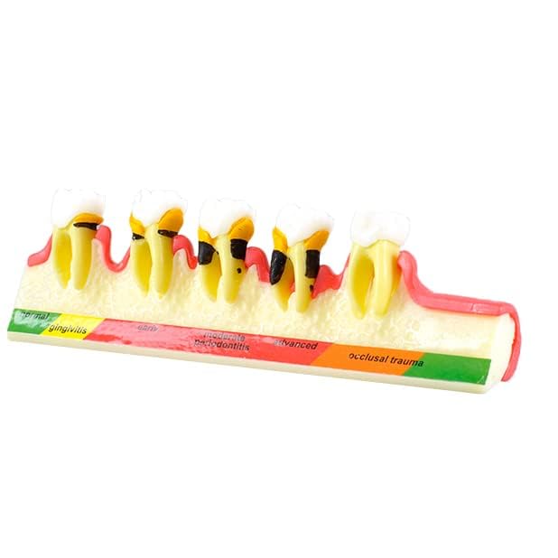 Global-Dental Model Periodontal Classification Model Periodontal Disease Model Dentist-Patient Communication Display Model