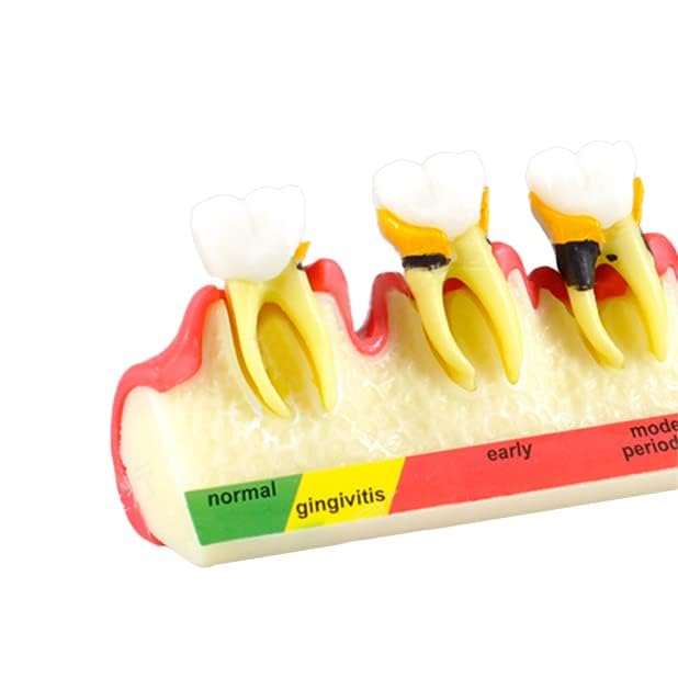 Global-Dental Model Periodontal Classification Model Periodontal Disease Model Dentist-Patient Communication Display Model