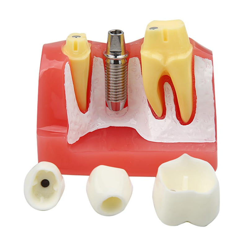 Dental Implant Model Removable Crown Bridge 4 Times Teeth Demonstration Model for Teaching Demonstration,Patient Education and Student Learning B