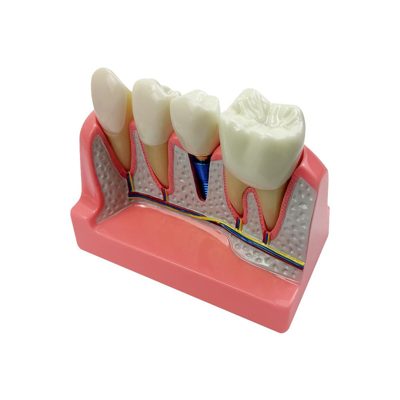 4 Times Dental Implant Model, Removable Teeth Model, Dental Implant, Crown and Bridge Model for Demonstration of Tooth Structure 4-tooth dental implant model