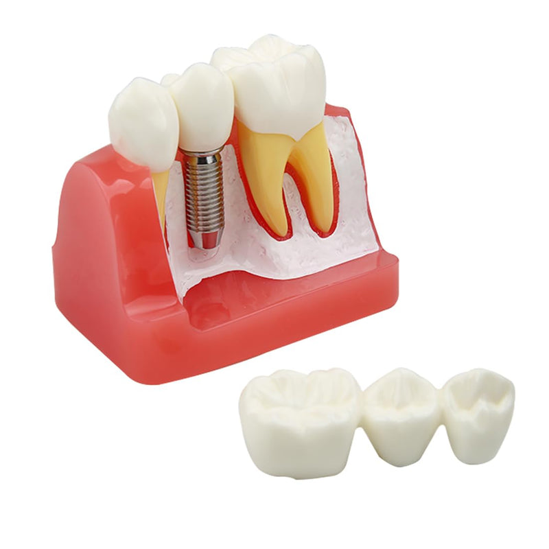Dental Implant Model Removable Crown Bridge 4 Times Teeth Demonstration Model for Teaching Demonstration,Patient Education and Student Learning B