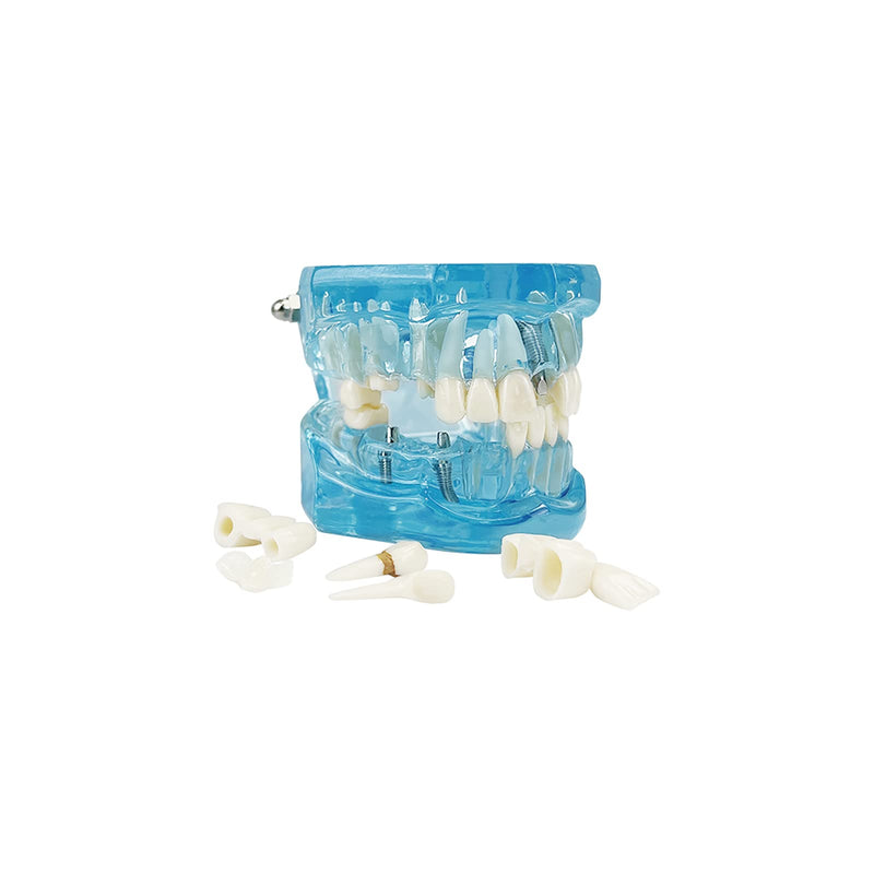 Transparent Disease Teeth Model, YOUYA DENTAL Transparent Dental Implant Teeth Model Dentist Standard Disease Removable Tooth Pathological Teaching Model(Blue)