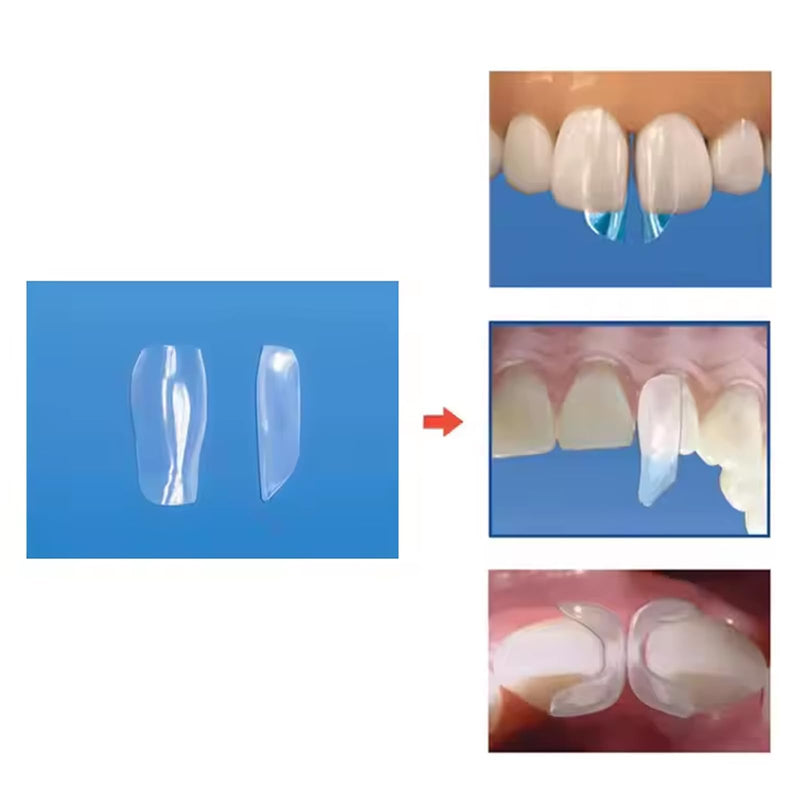 Dental Clear Matrix Anterior Matrice, BT Anterior Matrices Bioclear Style, Transparent Bow Anterior Matrices Sectional Contoured Matrix System (3, S/L/M) 3