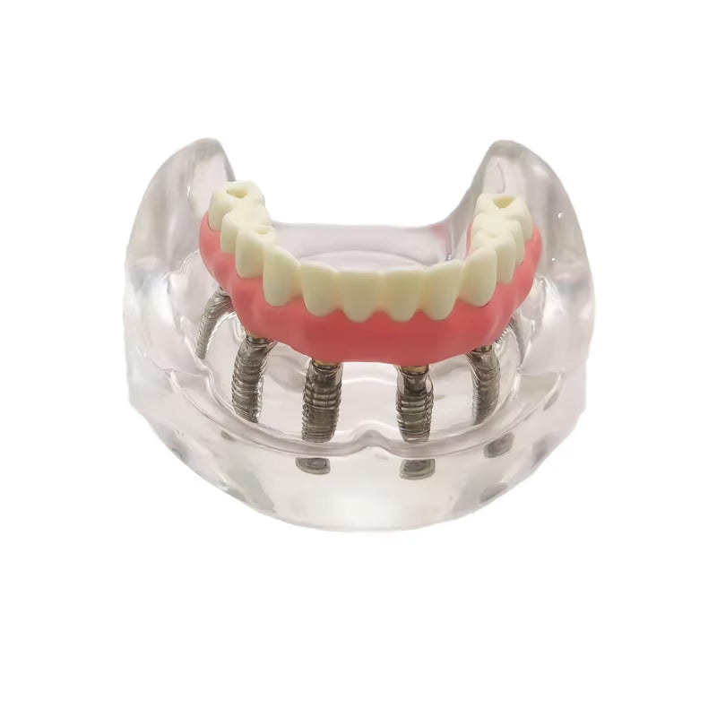 Dental Overdenture Inferior Model, 6 Nail Dental Implant Model Removable Demo Model for Researching Medical Dentist Teaching Studying