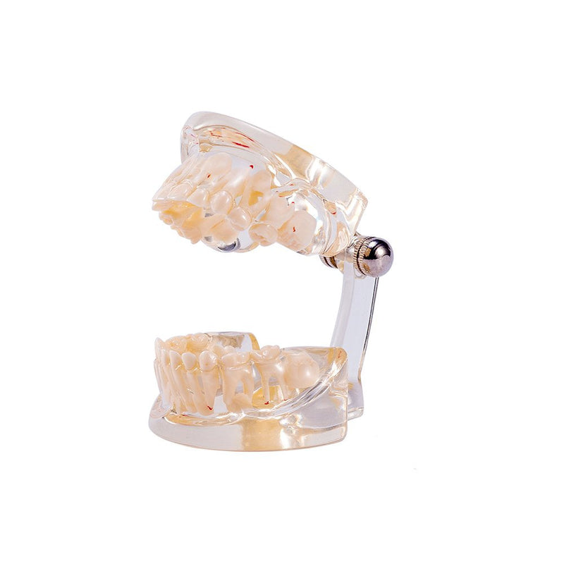 SNAWOP Dental Pathology Model Pediatric Teeth Model Clear Mixed Age Kids Disease Tooth Model
