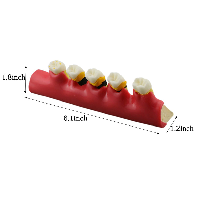 Dental Typodont Teeth Model M4010 Demonstrates The Progress of Periodontal Disease Category Pathology Dissect Teaching Study Demo