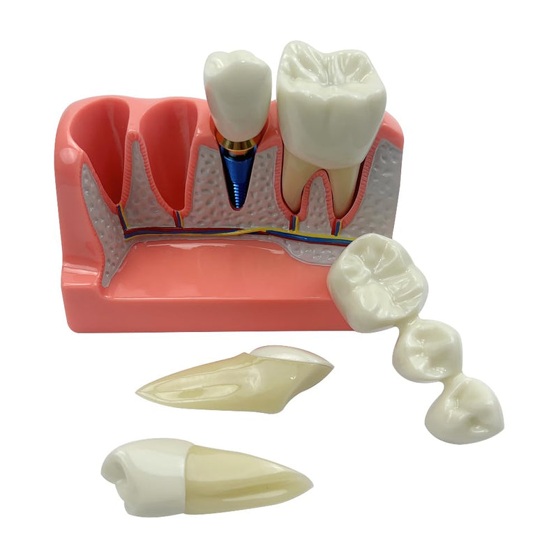 4 Times Dental Implant Model, Removable Teeth Model, Dental Implant, Crown and Bridge Model for Demonstration of Tooth Structure 4-tooth dental implant model