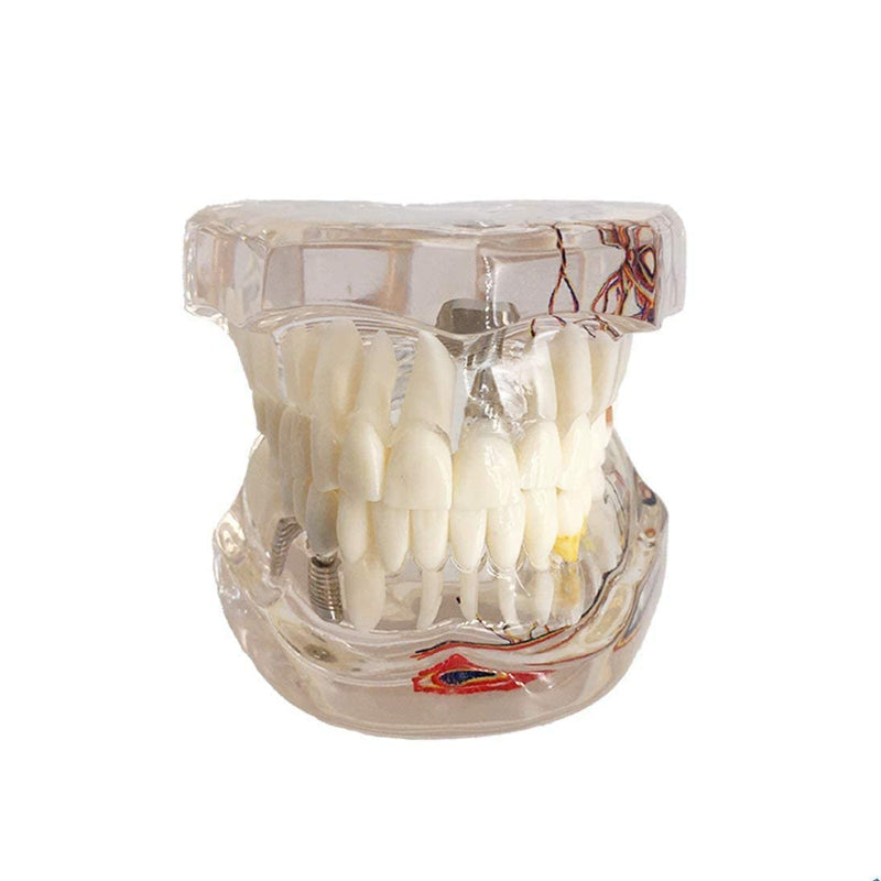 Neural Repair Dental Model Implant Disease Teeth Model Dentist Standard Pathological Removable Teeth Teaching Model for Dentist School Educating Learning