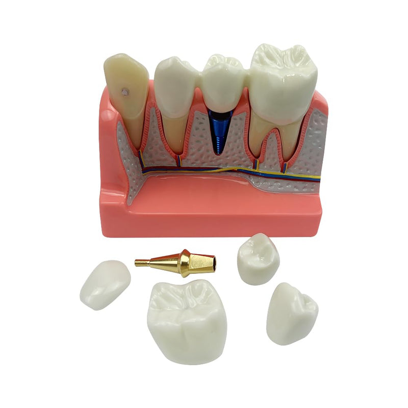 4 Times Dental Implant Model, Removable Teeth Model, Dental Implant, Crown and Bridge Model for Demonstration of Tooth Structure 4-tooth dental implant model