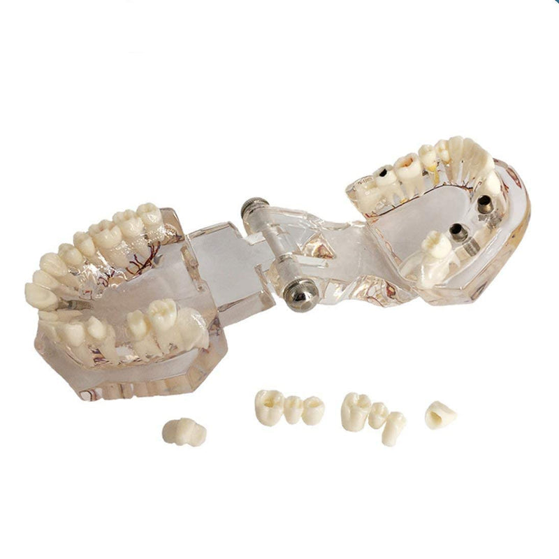 Neural Repair Dental Model Implant Disease Teeth Model Dentist Standard Pathological Removable Teeth Teaching Model for Dentist School Educating Learning