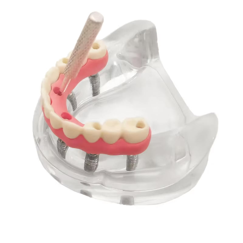 Dental Overdenture Inferior Model, 6 Nail Dental Implant Model Removable Demo Model for Researching Medical Dentist Teaching Studying