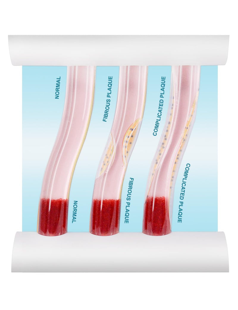 SimCoach Low-Density Lipoprotein LDL Blood Vessel Model for Medical Patient Doctor Teaching