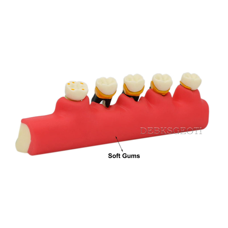 Dental Typodont Teeth Model M4010 Demonstrates The Progress of Periodontal Disease Category Pathology Dissect Teaching Study Demo