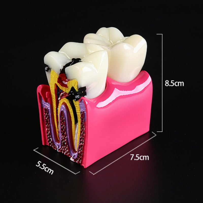 6 Times Dental Caries Model Teaching Typodont Tool for Dentists, Patients, Teachers and Students Studying and Researching (Teeth Removal) Teeth Removal