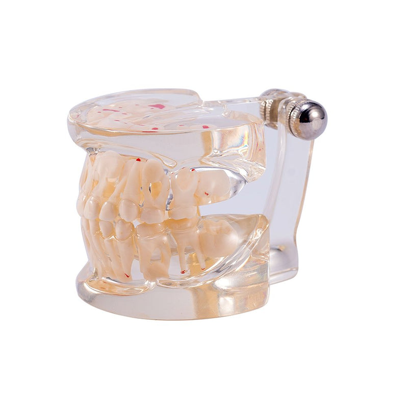 SNAWOP Dental Pathology Model Pediatric Teeth Model Clear Mixed Age Kids Disease Tooth Model