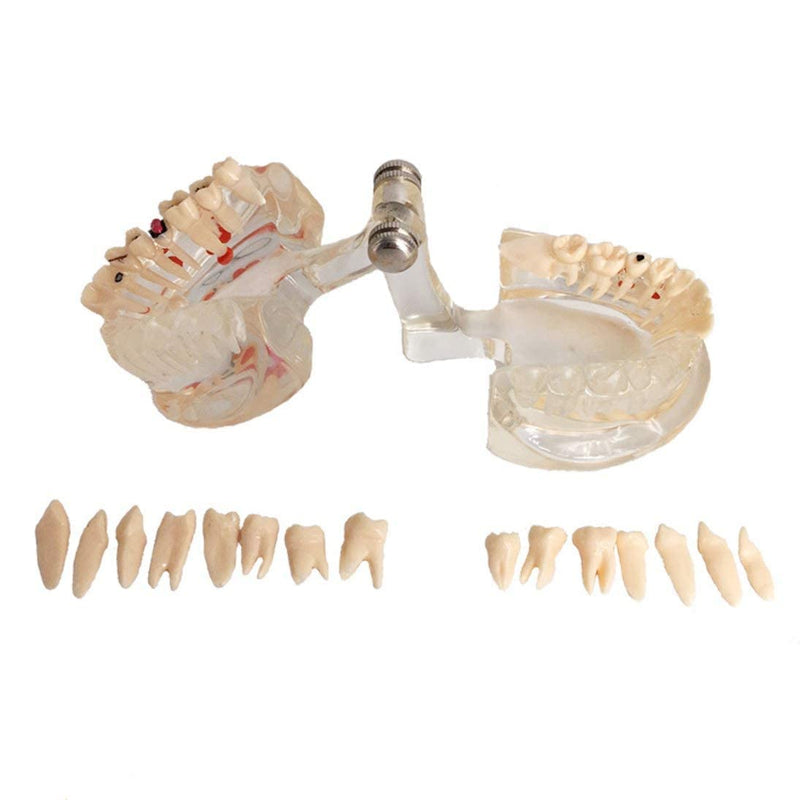 Neural Repair Dental Model Implant Disease Teeth Model Dentist Standard Pathological Removable Teeth Teaching Model for Dentist School Educating Learning