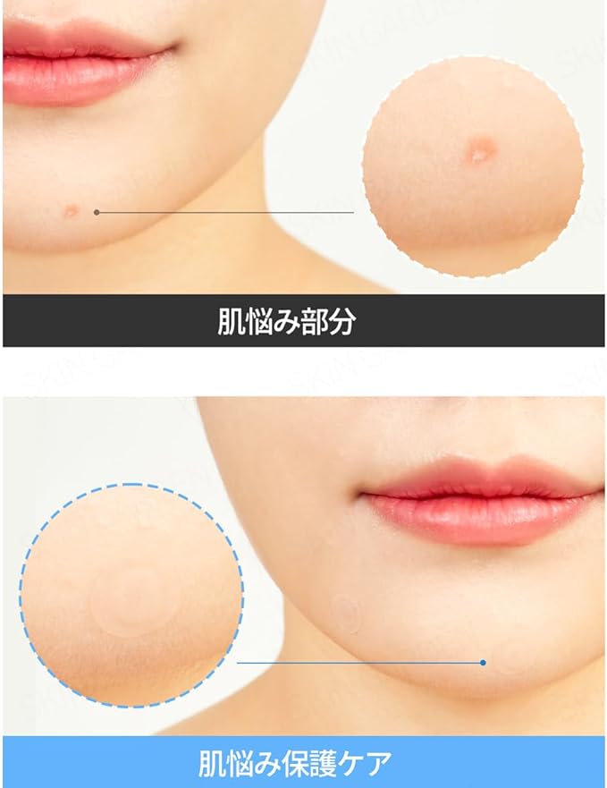 G9SKIN Official [Large Capacity 108 Pieces] New Zero Solution Spot Cover Patch Trouble Patch Gynine Skin ZERO SOLUTION SPOT COVER PATCH Korean Cosmetics - NewNest Australia