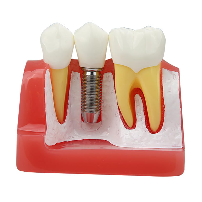 Dental Implant Model Removable Crown Bridge 4 Times Teeth Demonstration Model for Teaching Demonstration,Patient Education and Student Learning B