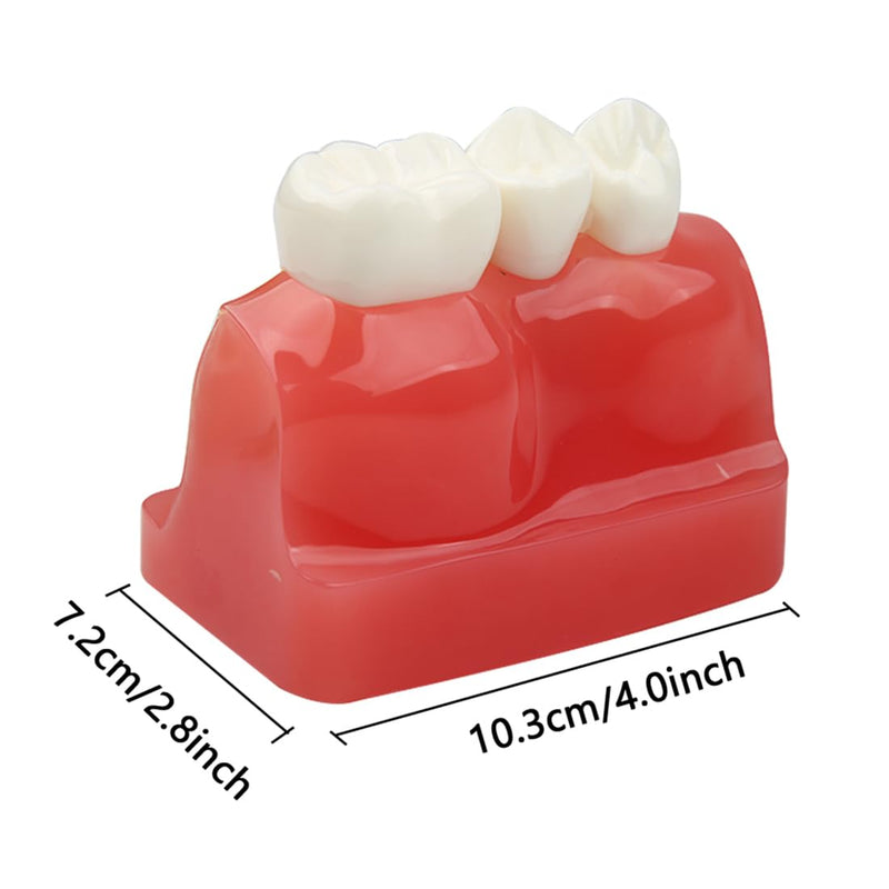 Dental Implant Model Removable Crown Bridge 4 Times Teeth Demonstration Model for Teaching Demonstration,Patient Education and Student Learning B