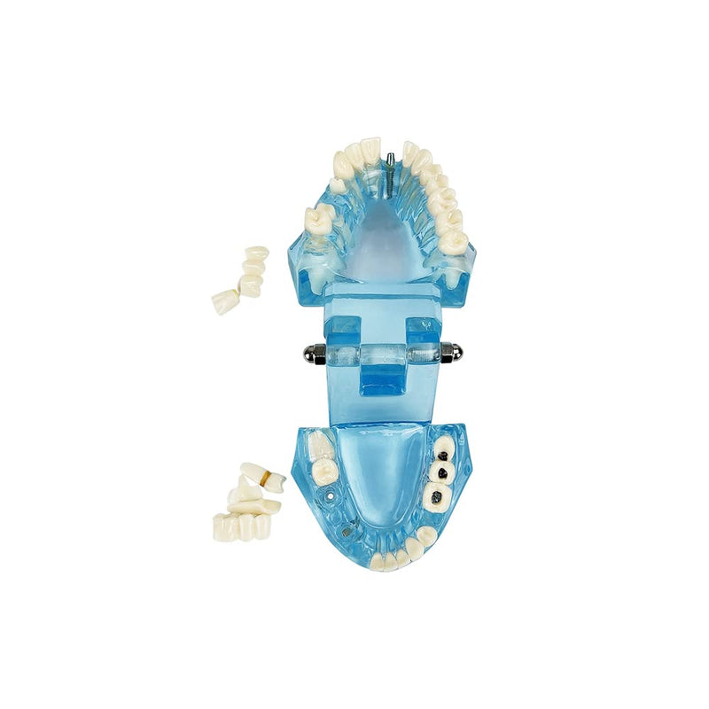 Transparent Disease Teeth Model, YOUYA DENTAL Transparent Dental Implant Teeth Model Dentist Standard Disease Removable Tooth Pathological Teaching Model(Blue)