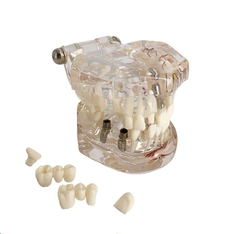 Neural Repair Dental Model Implant Disease Teeth Model Dentist Standard Pathological Removable Teeth Teaching Model for Dentist School Educating Learning