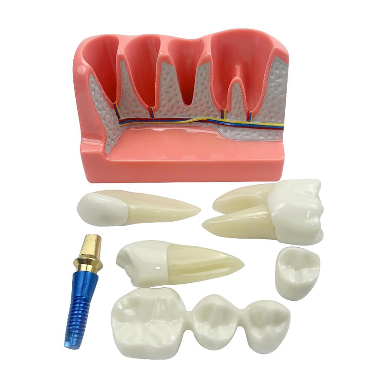 4 Times Dental Implant Model, Removable Teeth Model, Dental Implant, Crown and Bridge Model for Demonstration of Tooth Structure 4-tooth dental implant model