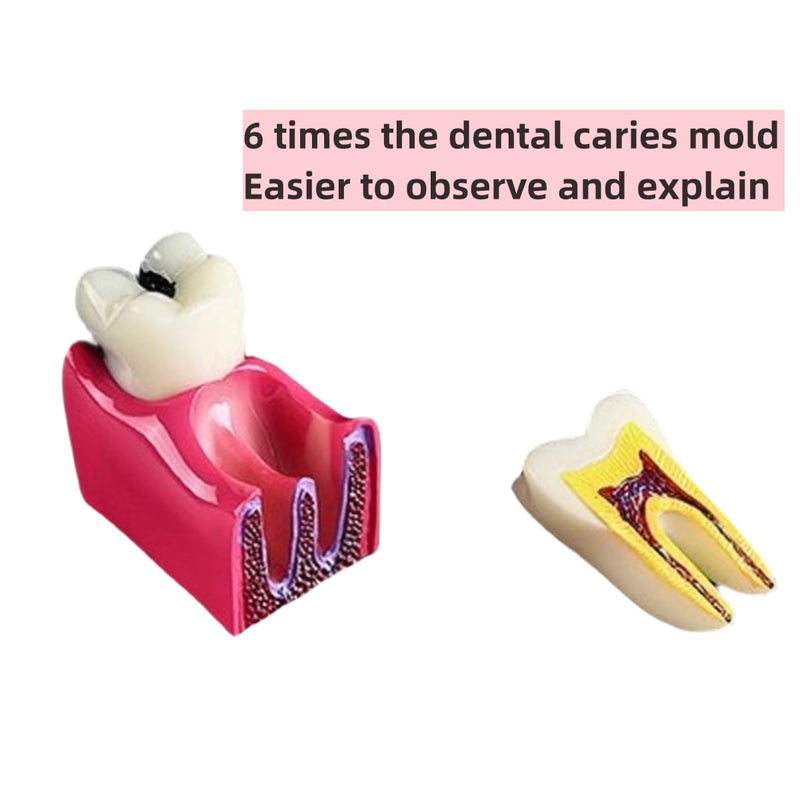 6 Times Dental Caries Model Teaching Typodont Tool for Dentists, Patients, Teachers and Students Studying and Researching (Teeth Removal) Teeth Removal