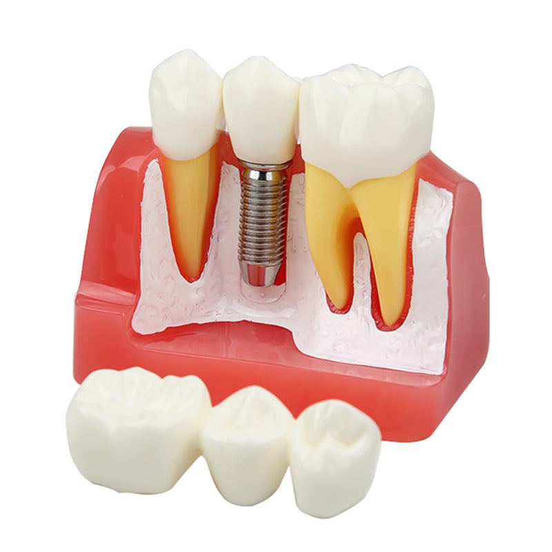 Dental Implant Model Removable Crown Bridge 4 Times Teeth Demonstration Model for Teaching Demonstration,Patient Education and Student Learning B