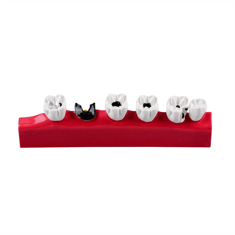 Dental Caries Developing Model, Dental Teeth Model for Dental Tooth Anatomy Study, Doctor-Patient and Oral Care Education Developing Decay Model