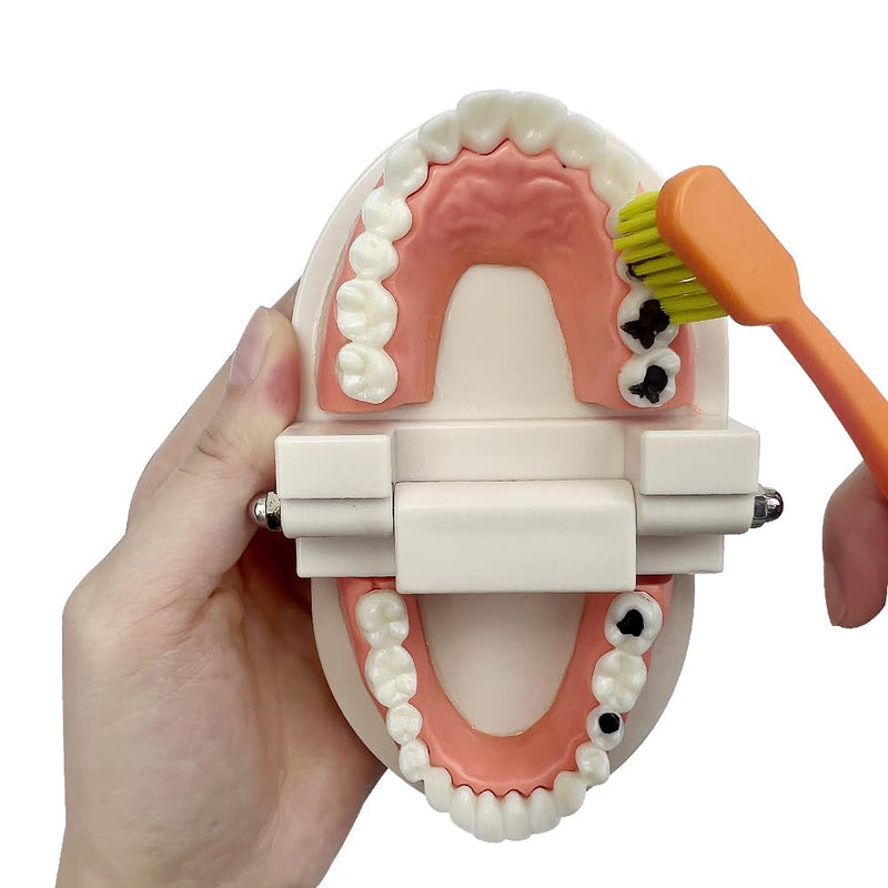 Decay Tooth Model, YOUYA Dental Caries Standard Teeth Teaching Model Study Tool Adult Disease Standard Typodont Demonstration Teeth Model for Kids Oral Care Teaching