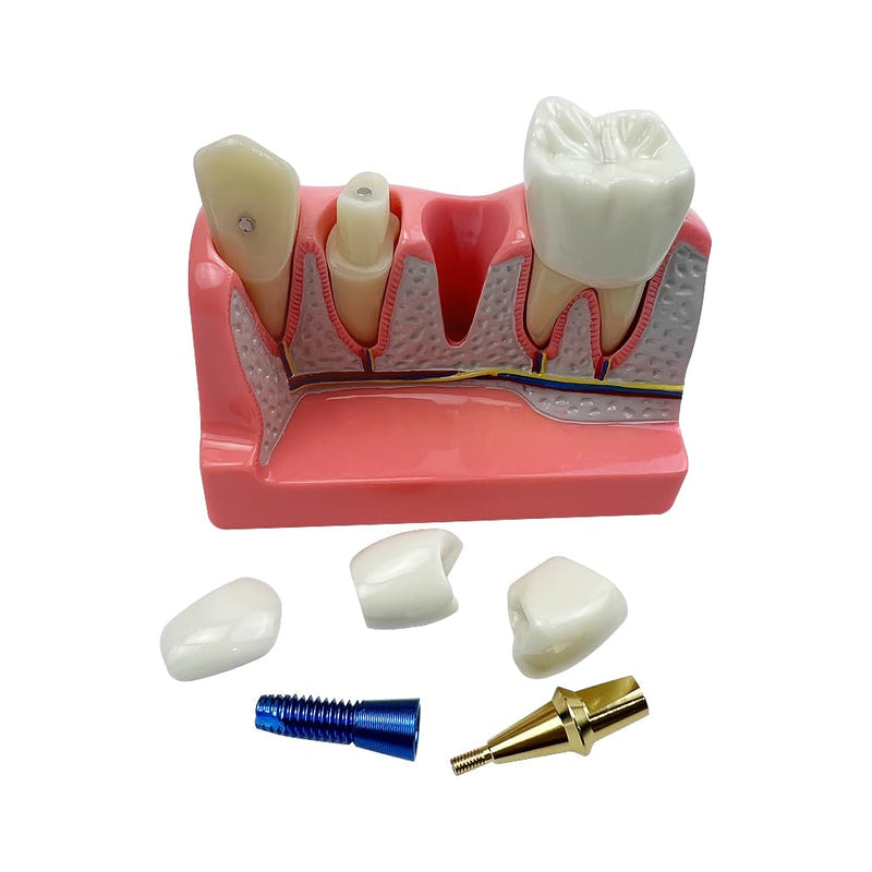 4 Times Dental Implant Model, Removable Teeth Model, Dental Implant, Crown and Bridge Model for Demonstration of Tooth Structure 4-tooth dental implant model