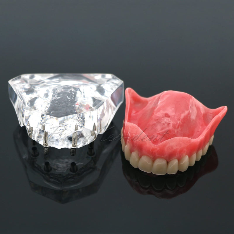 Dental Implant Typodont Restoration Teeth Model M6001 Clear Overdenture 4 Implants Superior Upper Demo for Study Teach