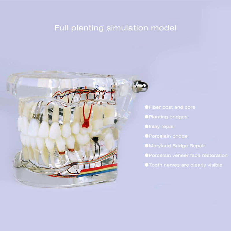 Neural Repair Dental Model Implant Disease Teeth Model Dentist Standard Pathological Removable Teeth Teaching Model for Dentist School Educating Learning