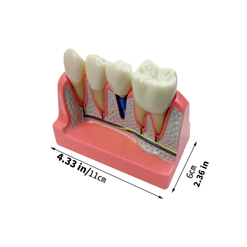 4 Times Dental Implant Model, Removable Teeth Model, Dental Implant, Crown and Bridge Model for Demonstration of Tooth Structure 4-tooth dental implant model