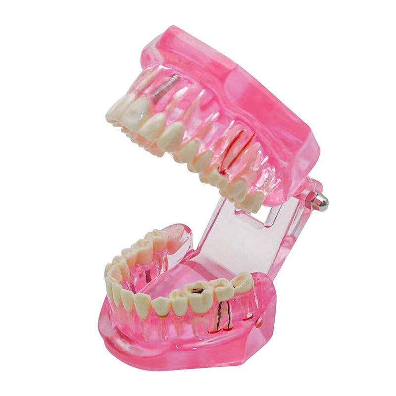 Transparent Disease Teeth Model with Dental Implant Bridge, Dental Teach Crown Bridge Removable Model, Tooth Model for Patient and Dental Student Education. (Red) Red