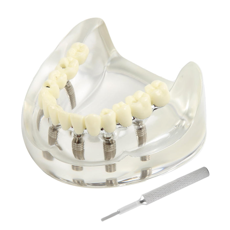 Dental Implant Model Transparent Upper Jaw with 6 Implants Removable Screws | Overdenture Restoration, Dental School Teaching Lab Demo, Patient Education