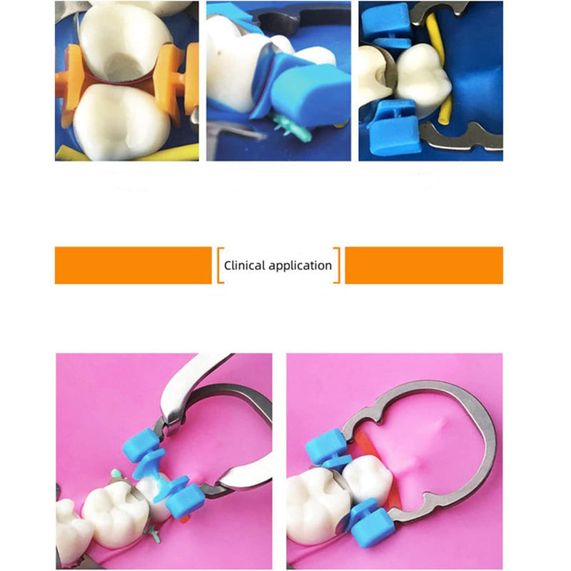 Dental Sectional Contoured Matrix Ring, Autoclavable Dental Nickel Titanium Clamp Clip Ring, Dental Sectional Matrix Ring, Elastic Clamping Ring Separator Ring. (Blue) Blue