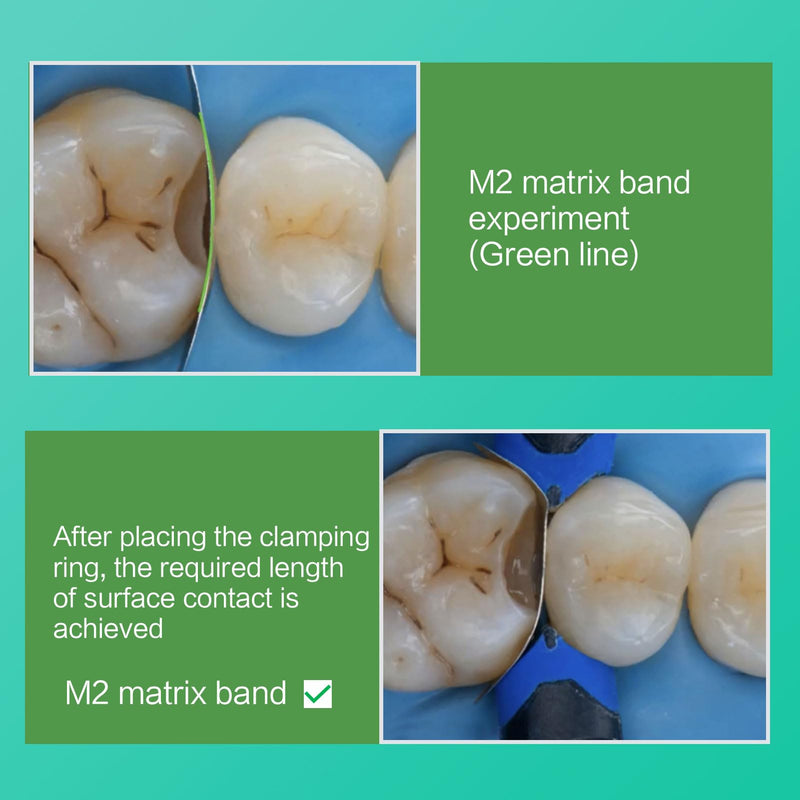 Dental Sectional Matrix System Kit, Dental Sectional Matrix Resin Clip Clamping Ring, M2 Dental Matrix Bands Suitable for Repairing Longer Surface Contacts.