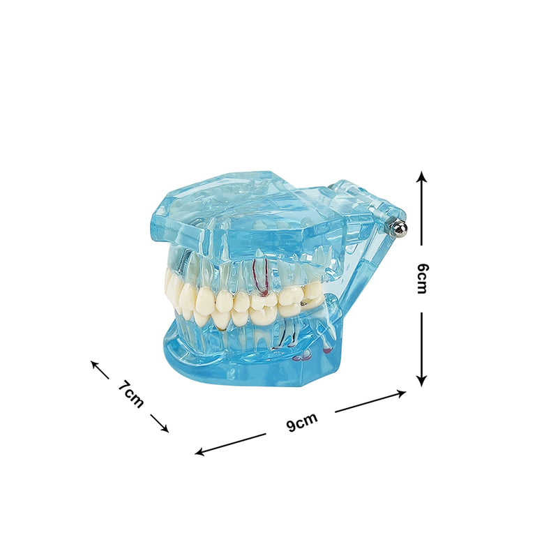 Transparent Disease Teeth Model, YOUYA DENTAL Transparent Dental Implant Teeth Model Dentist Standard Disease Removable Tooth Pathological Teaching Model(Blue)