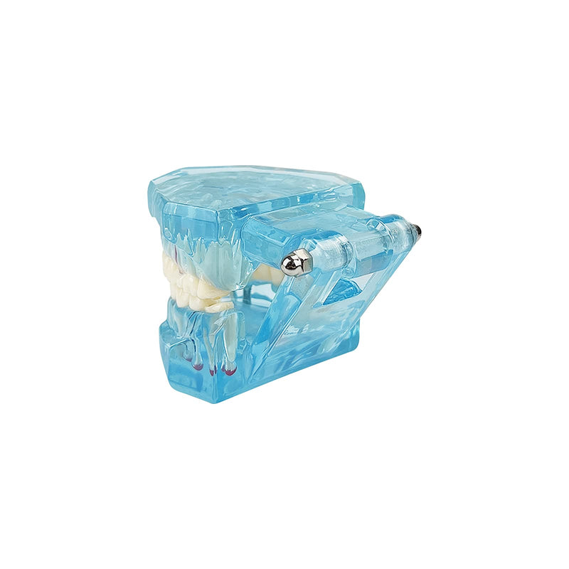 Transparent Disease Teeth Model, YOUYA DENTAL Transparent Dental Implant Teeth Model Dentist Standard Disease Removable Tooth Pathological Teaching Model(Blue)