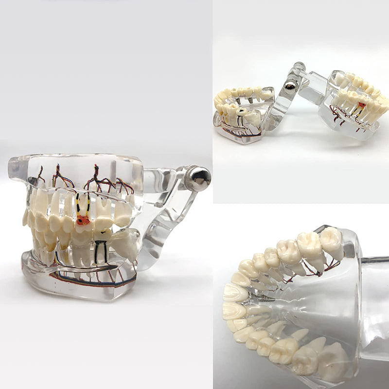 Neural Repair Dental Model Implant Disease Teeth Model Dentist Standard Pathological Removable Teeth Teaching Model for Dentist School Educating Learning