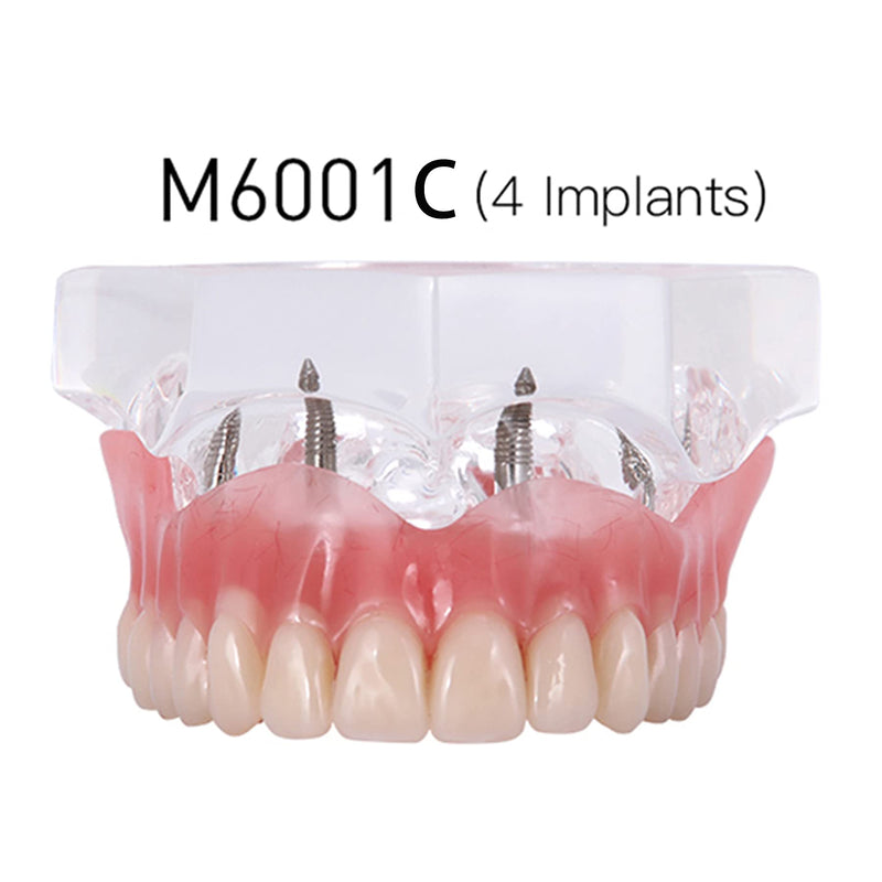 Dental Implant Typodont Restoration Teeth Model M6001 Clear Overdenture 4 Implants Superior Upper Demo for Study Teach