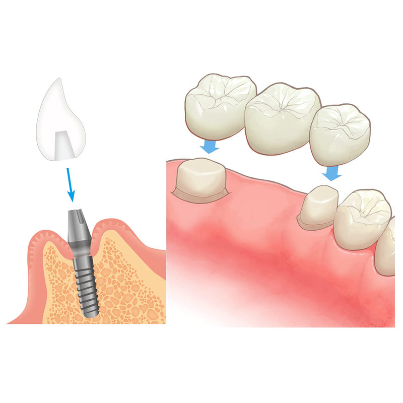Dental Implant Typodont Restoration Teeth Model M6006 Overdenture 3 Implants Bridge Inferior Lower Treatment Demo for Study Teach