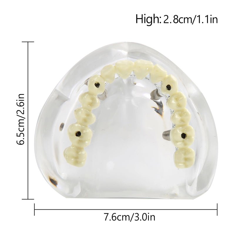 Dental Overdenture Inferior Model 4 Implants Upper Jaw Removable Demo Model | For Dentist Education and Study