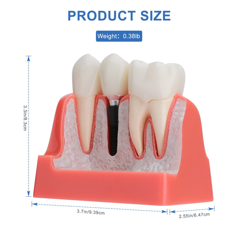 Dental Implant Model - Implant Vs Bridge Dental Model 4 Times Removable Analysis Crown Bridge Demonstration Teeth Model