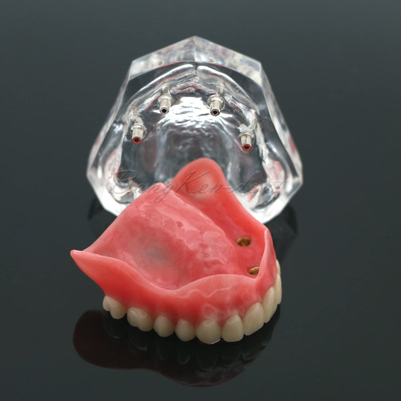 Dental Implant Typodont Restoration Teeth Model M6001 Clear Overdenture 4 Implants Superior Upper Demo for Study Teach