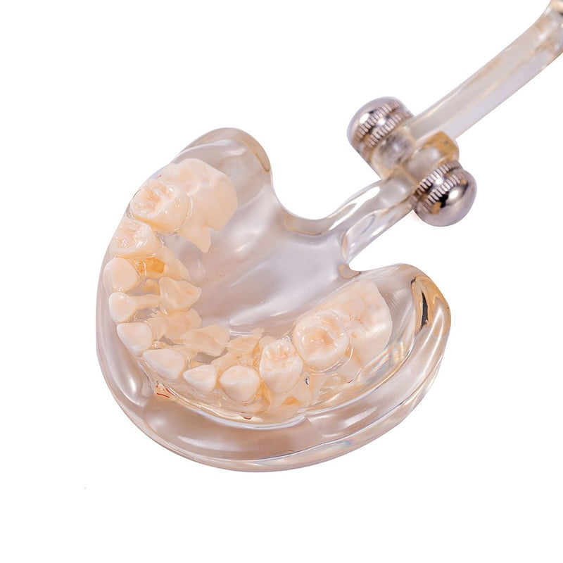 SNAWOP Dental Pathology Model Pediatric Teeth Model Clear Mixed Age Kids Disease Tooth Model