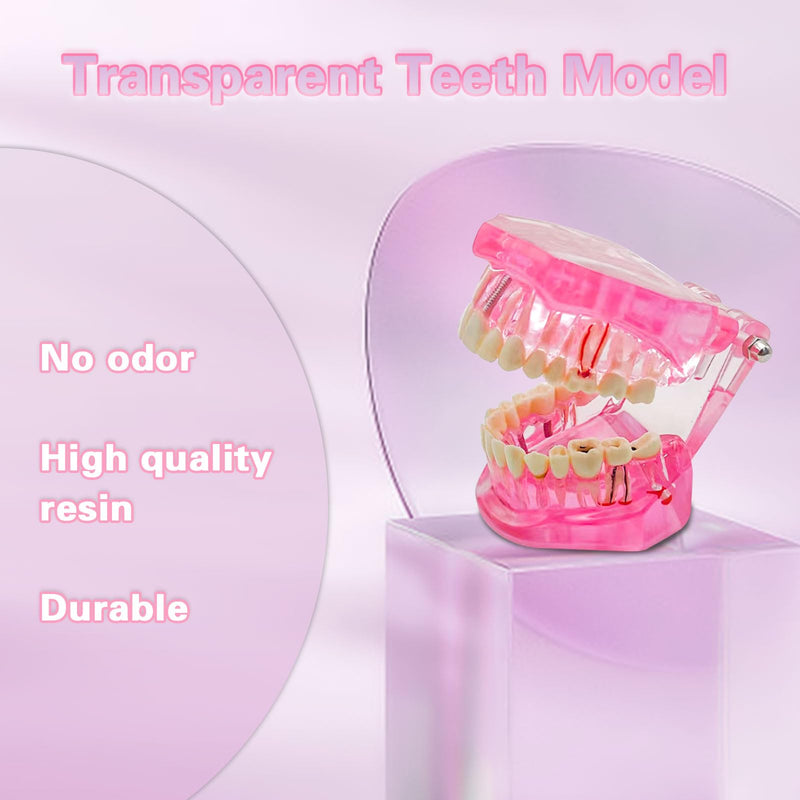 Transparent Disease Teeth Model with Dental Implant Bridge, Dental Teach Crown Bridge Removable Model, Tooth Model for Patient and Dental Student Education. (Red) Red